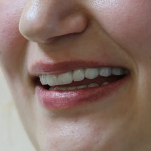✨ Rezultat i pastër dhe estetikNë Binaj Dental Clinic kujdesemi që çdo trajtim të jetë i rehatsh